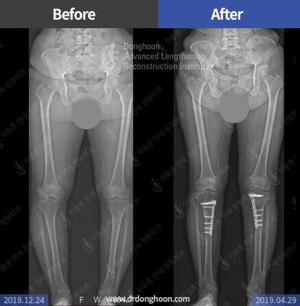 Osteotomy for Arthritis – Limb Lengthening & Complex Reconstruction ...