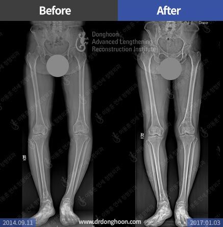 Osteotomy for Arthritis – Limb Lengthening & Complex Reconstruction ...