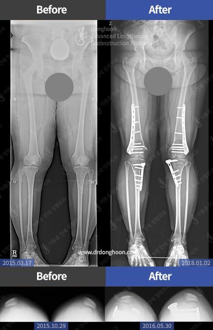 recurrent dislocation patella icd 10