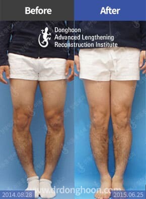 Bowlegs – Limb Lengthening & Complex Reconstruction Service: Korea | DALRI