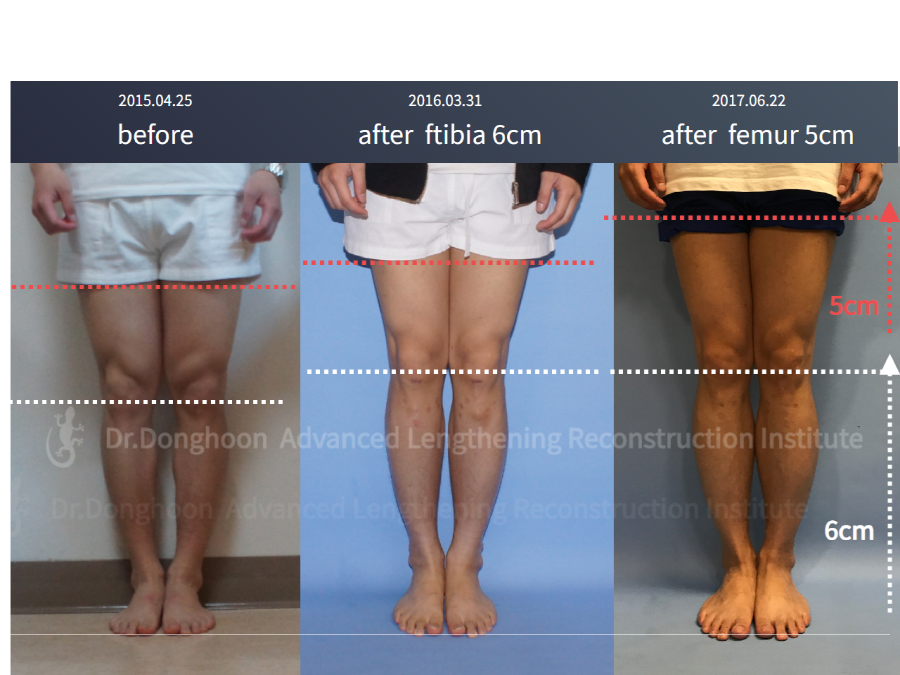 6cm of Tibial Lengthening + 5cm Femoral Lengthening by PRECICE Limb