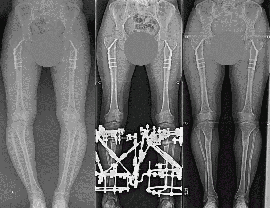 External Fixation Limb Lengthening & Complex Reconstruction Service
